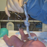 sangre cordón umbilical y obtención de células madre
