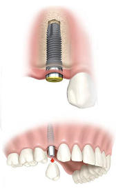 Implantes dentales Implantes dentales